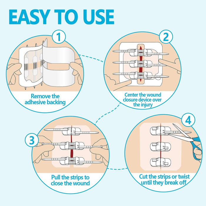 Senvok Wound Closure Device(Mix 4 PCS)