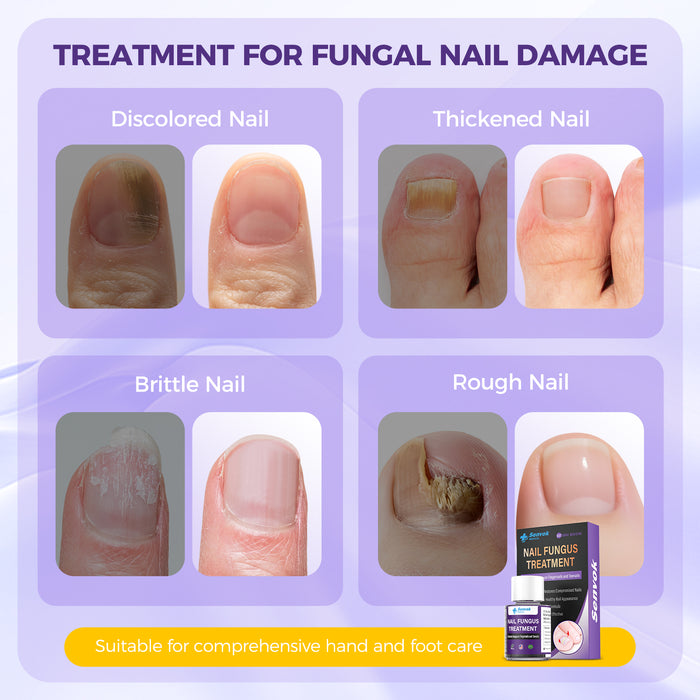 Senvok Nail Fungus Treatment